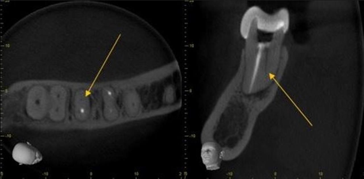 Uses Of Cbct In Endodontics