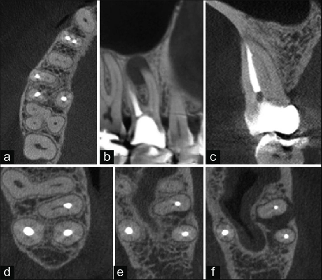 3D Imaging and Endodontics | Cavendish Imaging